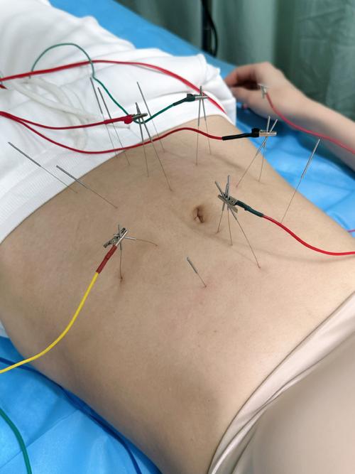 温州哪里有针灸减肥