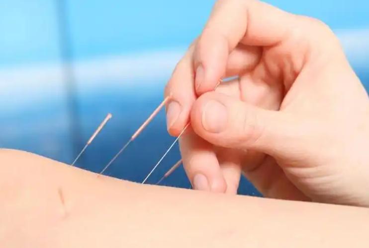 针灸无痛进针法视频