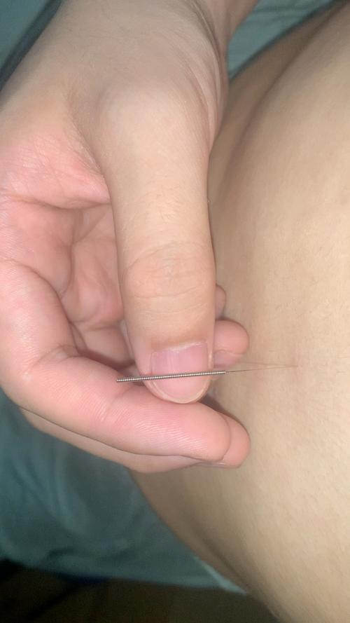 针灸治疗胃病要几天