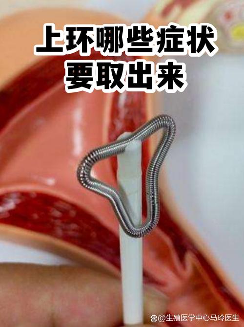 目前哪种环最好最安全