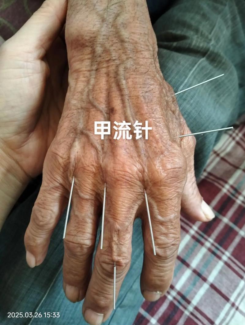 针灸刺针来治疗疾病