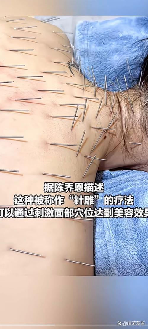 西安哪里有针灸丰胸