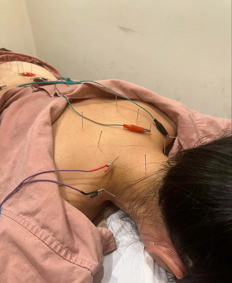 西安哪里有针灸丰胸