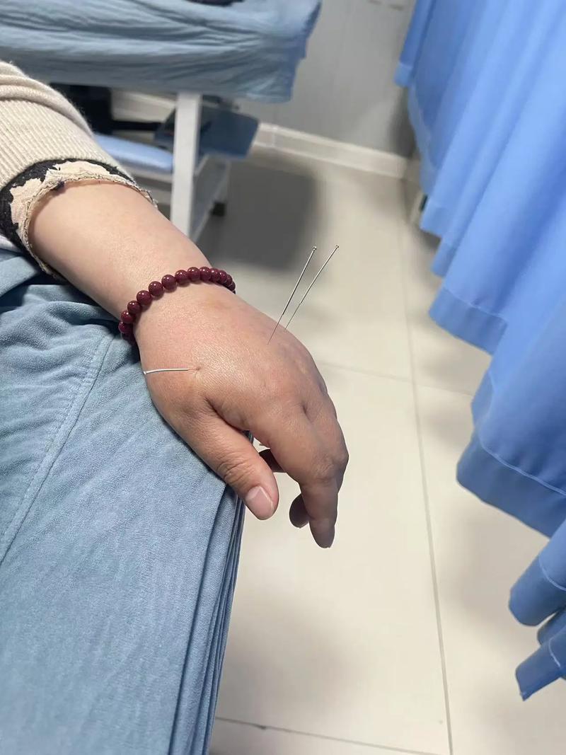 胃酸打嗝针灸治好吗