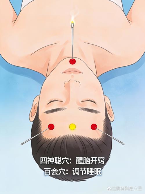 失眠针灸几次能见效