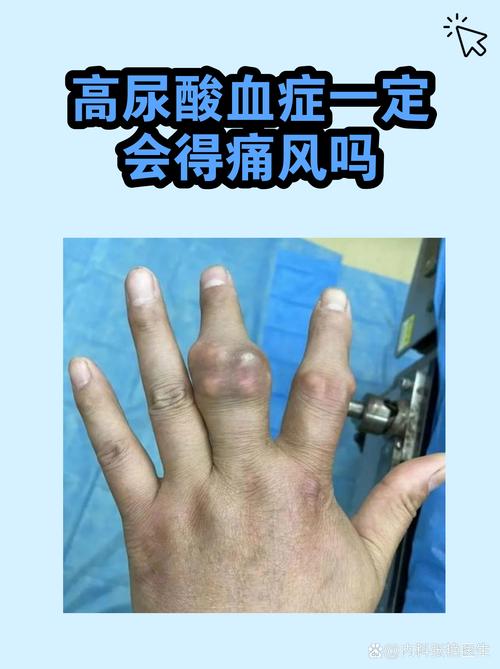 痛风病人的护理文档