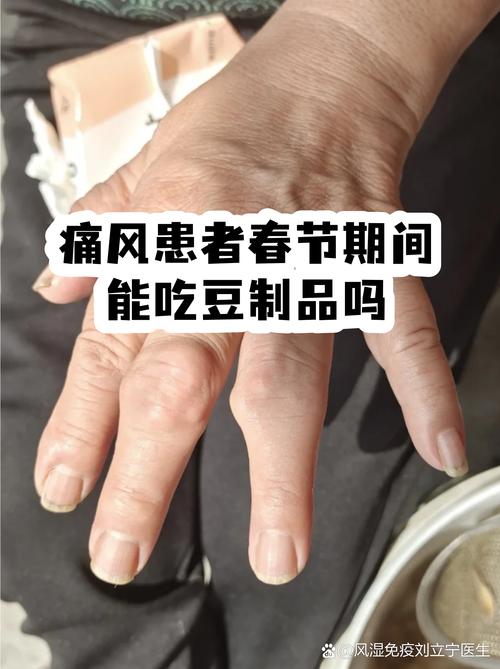 黄豆皮吃了会痛风吗