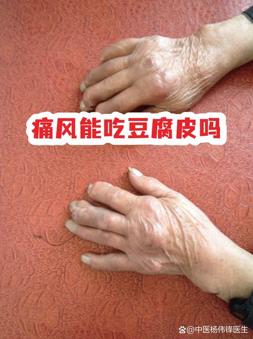 黄豆皮吃了会痛风吗