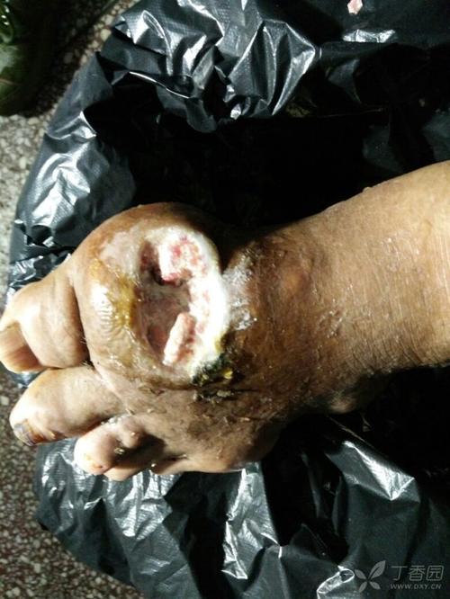 痛风石溃烂挂什么科