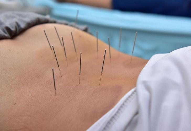 针灸治疗腰腿痛视频