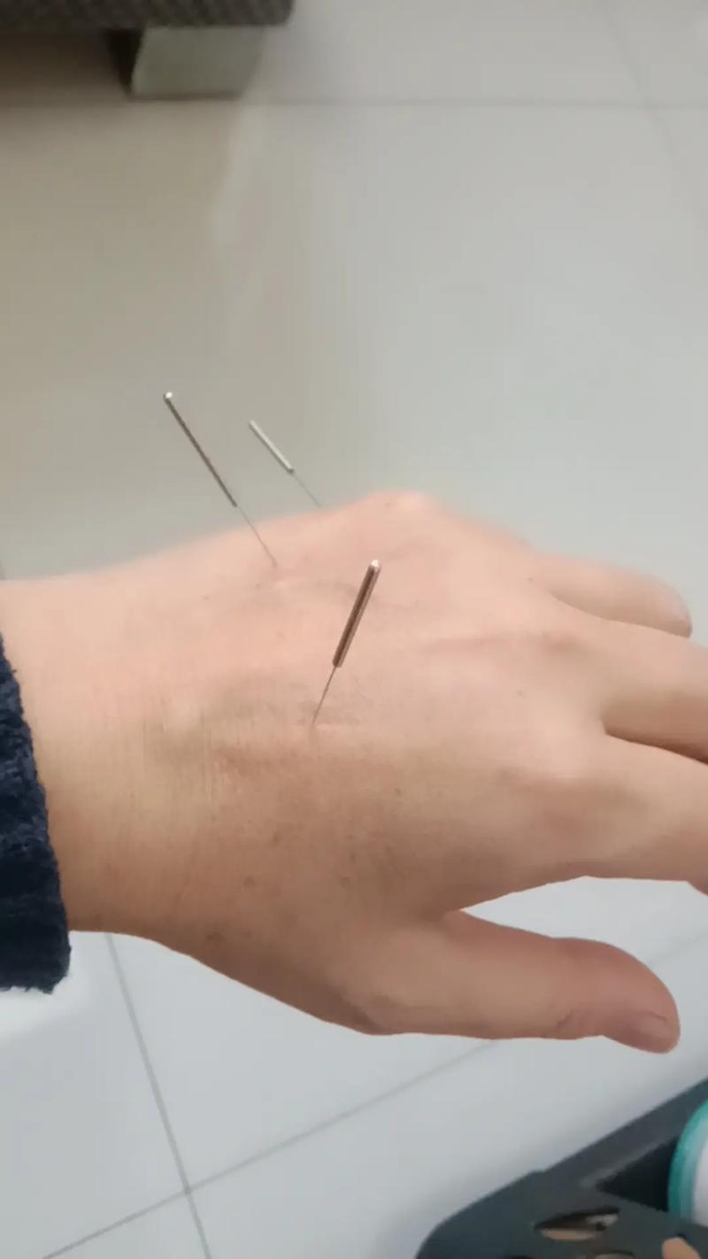 针灸治疗腰腿痛视频