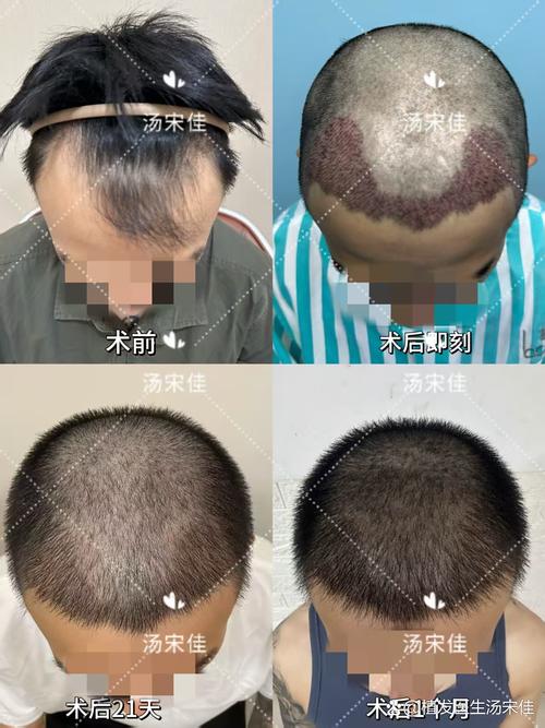 毛发种植海峡植发安全
