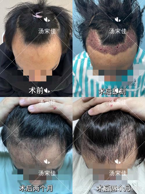 毛发种植海峡植发安全