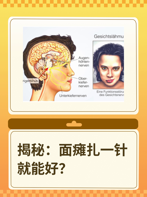 针灸治疗面瘫ppt