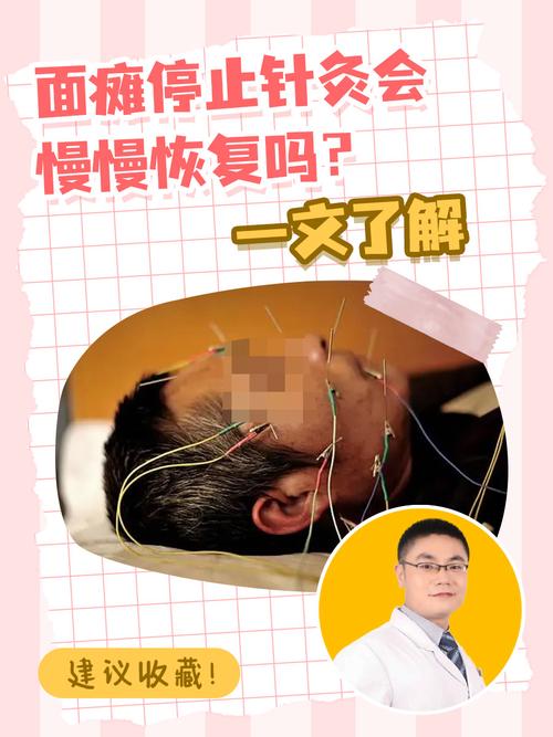 针灸治疗面瘫ppt