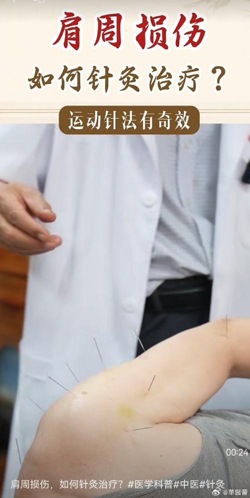 平衡针灸治疗肩周炎