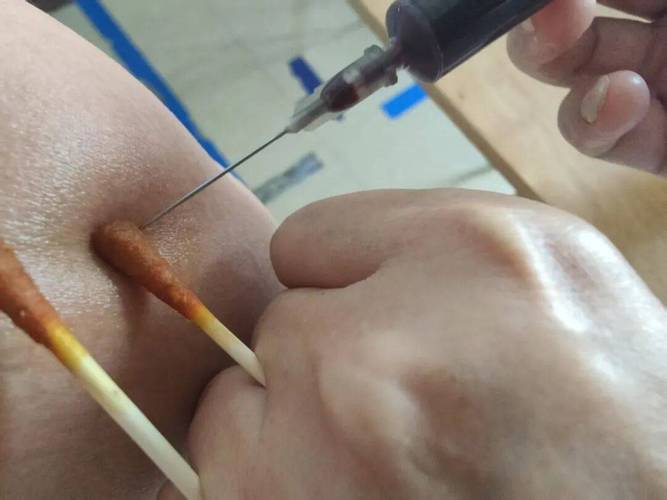 中央静脉堵塞 针灸