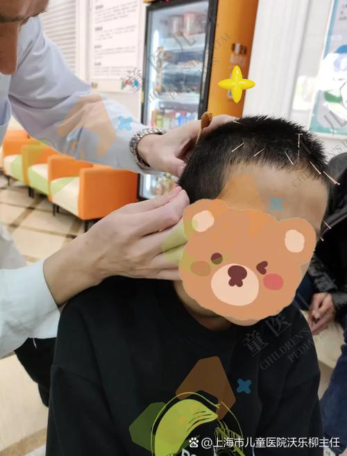 针灸治疗小儿多动症