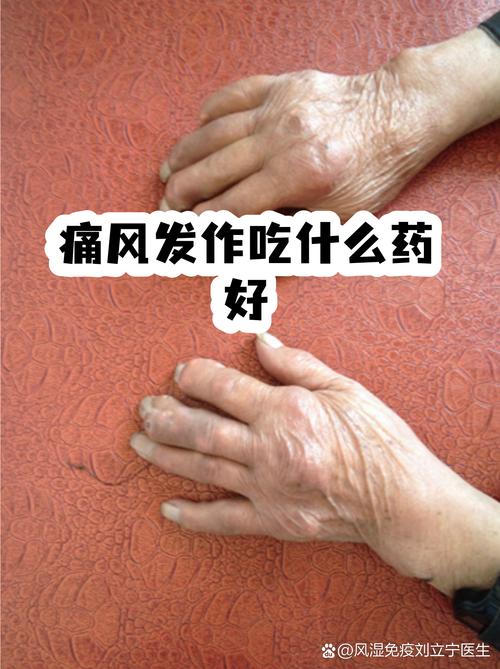 痛风好了还要吃药吗