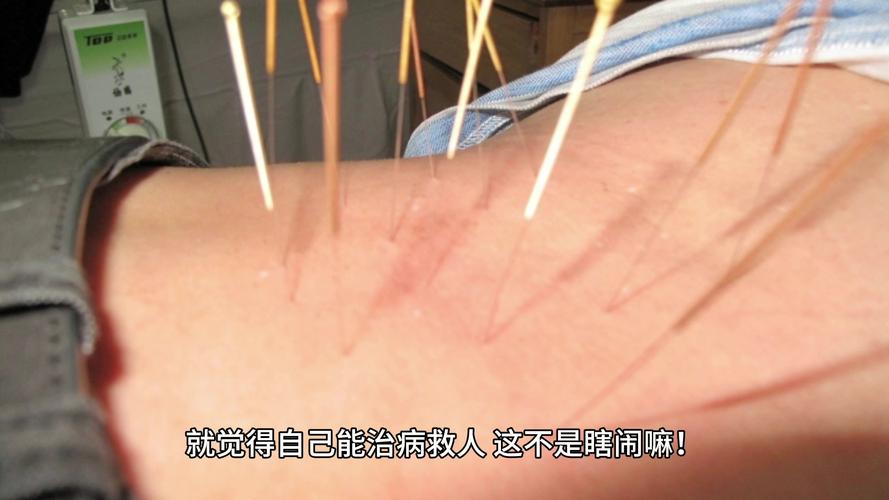 针灸视频 免费下载