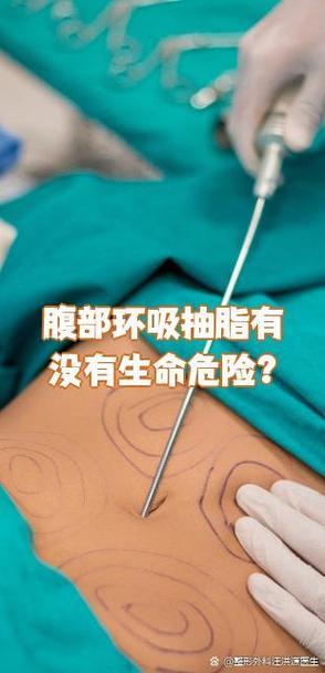 肚子吸脂肪手术安全吗