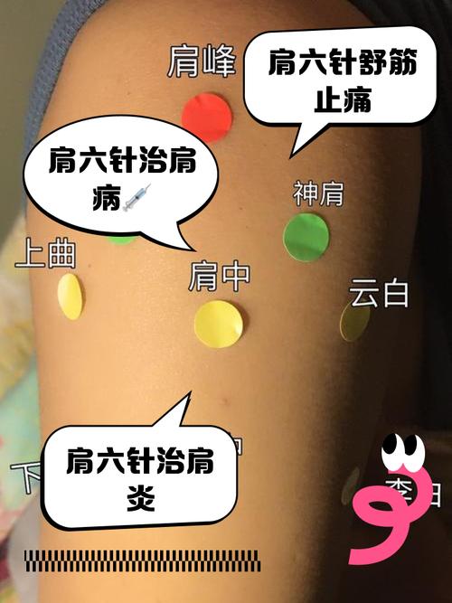 肩周炎针灸哪些部位