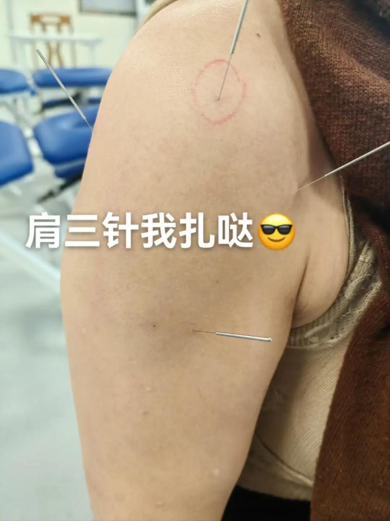 肩周炎针灸哪些部位