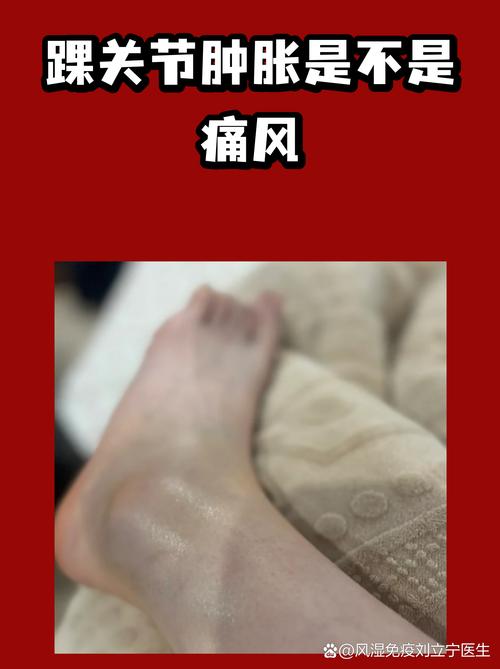 踝关节肿痛是痛风吗