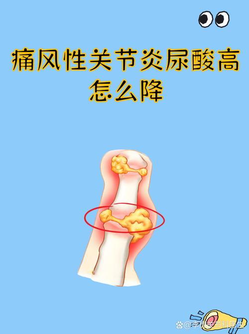 痛风排酸胶囊那里卖