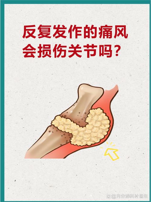 日本痛风研究新进展