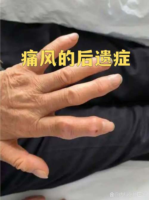 痛风需要核磁共振吗