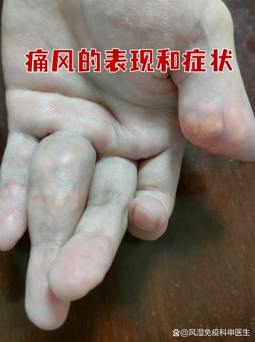 痛风需要核磁共振吗