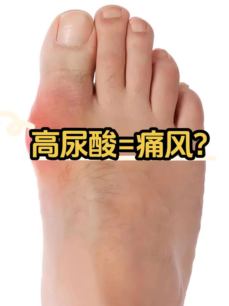 尿酸低会引起痛风吗