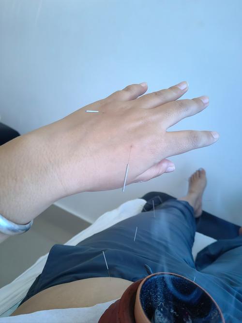 针灸治更年期综合症