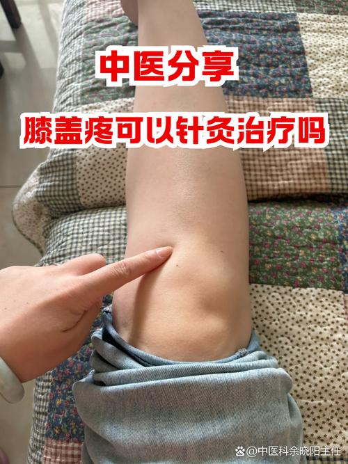 膝关节痛的针灸治疗